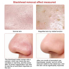 Suction Blackhead Remover